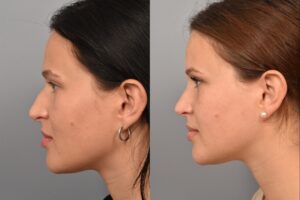 Left side of image is of a female patient's face showing her left profile before undergoing a rhinoplasty procedure with Dr. Pearlman. Right side of picture is the same female with the same view except it is after her rhinoplasty procedure. This is a side by side comparison of her rhinoplasty results before and after surgery