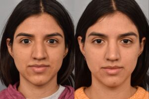 Left side of image is of a female patient's face showing her from a front on view before undergoing a rhinoplasty procedure with Dr. Pearlman. Right side of picture is the same female with the same view except it is after her rhinoplasty procedure. This is a side by side comparison of her rhinoplasty results before and after surgery