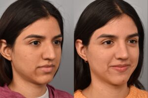 Left side of image is of a female patient's face showing her right 3/4 view before undergoing a rhinoplasty procedure with Dr. Pearlman. Right side of picture is the same female with the same view except it is after her rhinoplasty procedure. This is a side by side comparison of her rhinoplasty results before and after surgery