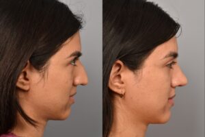 Left side of image is of a female patient's face showing her right profile before undergoing a rhinoplasty procedure with Dr. Pearlman. Right side of picture is the same female with the same view except it is after her rhinoplasty procedure. This is a side by side comparison of her rhinoplasty results before and after surgery