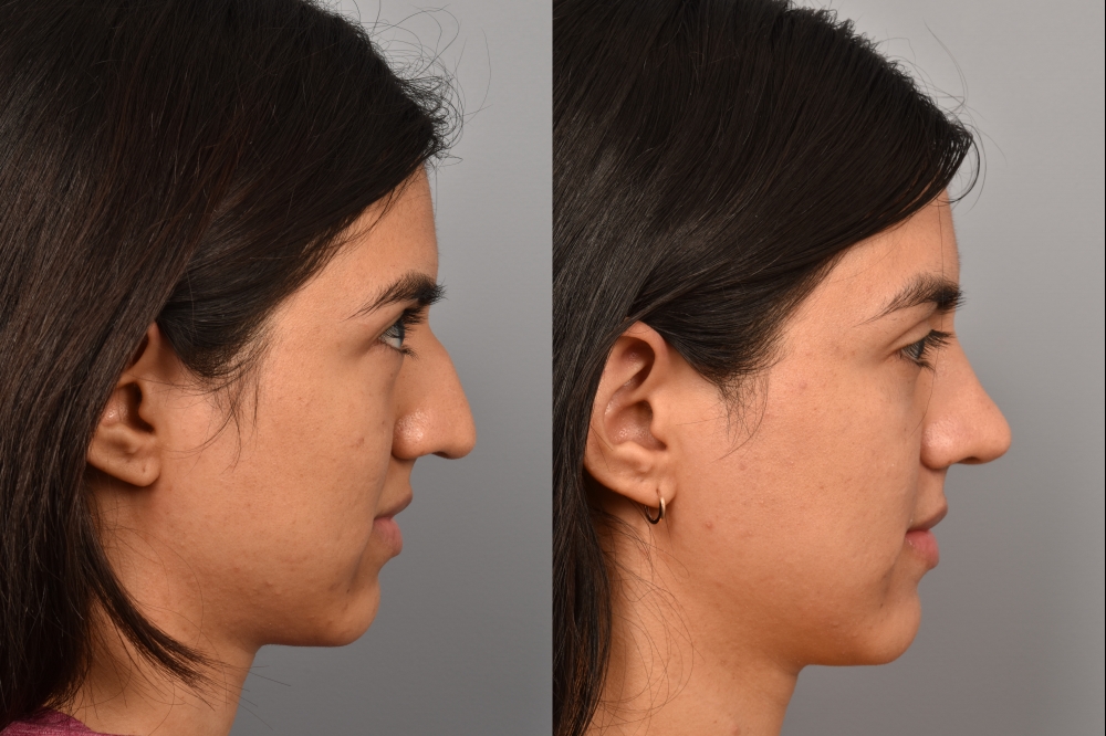 Left side of image is of a female patient's face showing her right profile before undergoing a rhinoplasty procedure with Dr. Pearlman. Right side of picture is the same female with the same view except it is after her rhinoplasty procedure. This is a side by side comparison of her rhinoplasty results before and after surgery