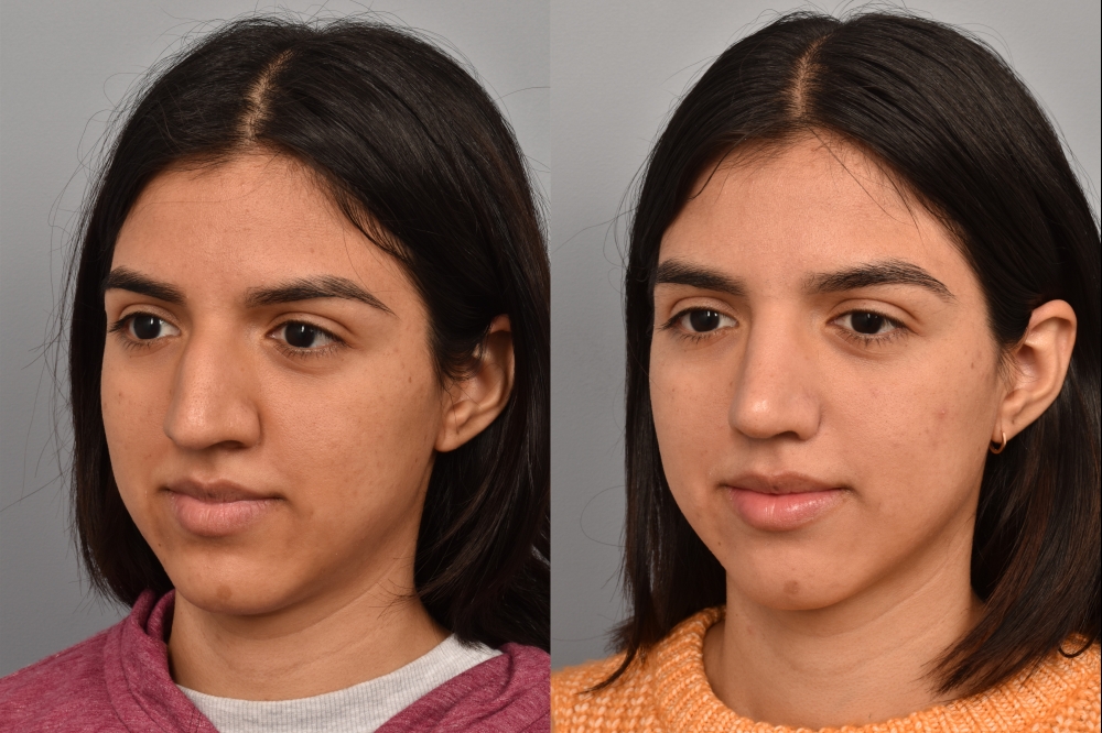 Left side of image is of a female patient's face showing her left 3/4 view before undergoing a rhinoplasty procedure with Dr. Pearlman. Right side of picture is the same female with the same view except it is after her rhinoplasty procedure. This is a side by side comparison of her rhinoplasty results before and after surgery