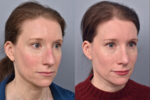 Left side of image is of a female patient's face showing her right 3/4 view before undergoing a rhinoplasty procedure with Dr. Pearlman. Right side of picture is the same female with the same view except it is after her rhinoplasty procedure. This is a side by side comparison of her rhinoplasty results before and after surgery