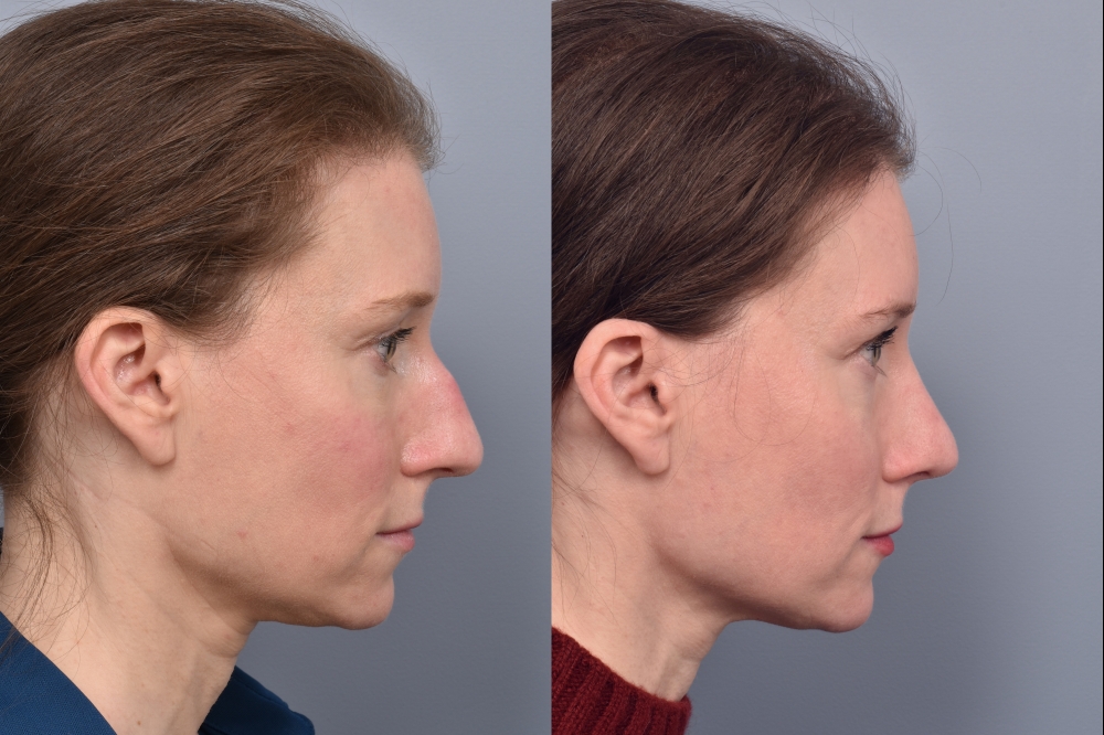 Left side of image is of a female patient's face showing her right profile before undergoing a rhinoplasty procedure with Dr. Pearlman. Right side of picture is the same female with the same view except it is after her rhinoplasty procedure. This is a side by side comparison of her rhinoplasty results before and after surgery