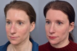 Left side of image is of a female patient's face showing her left 3/4 view before undergoing a rhinoplasty procedure with Dr. Pearlman. Right side of picture is the same female with the same view except it is after her rhinoplasty procedure. This is a side by side comparison of her rhinoplasty results before and after surgery