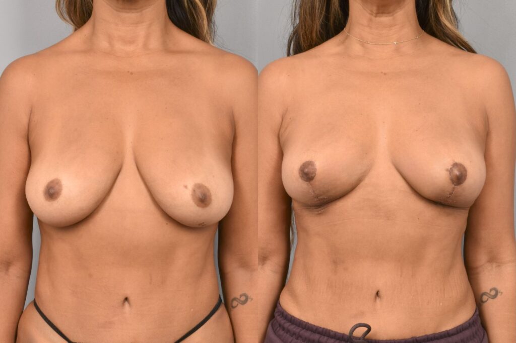 Side-by-side comparison of a female patient's straight-on view before and after breast lift by Dr. Bassiri-Tehrani. The left image shows her breast prior to surgery; the right image shows the same angle post-procedure