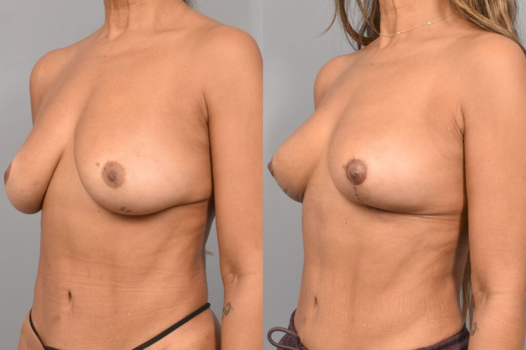 Side-by-side comparison of a female patient's left 3/4 view before and after breast lift by Dr. Bassiri-Tehrani. The left image shows her breast prior to surgery; the right image shows the same angle post-procedure