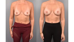 Side-by-side comparison of a female patient's straight-on view before and after breast augmentation by Dr. Bassiri-Tehrani. The left image shows her breast prior to surgery; the right image shows the same angle post-procedure