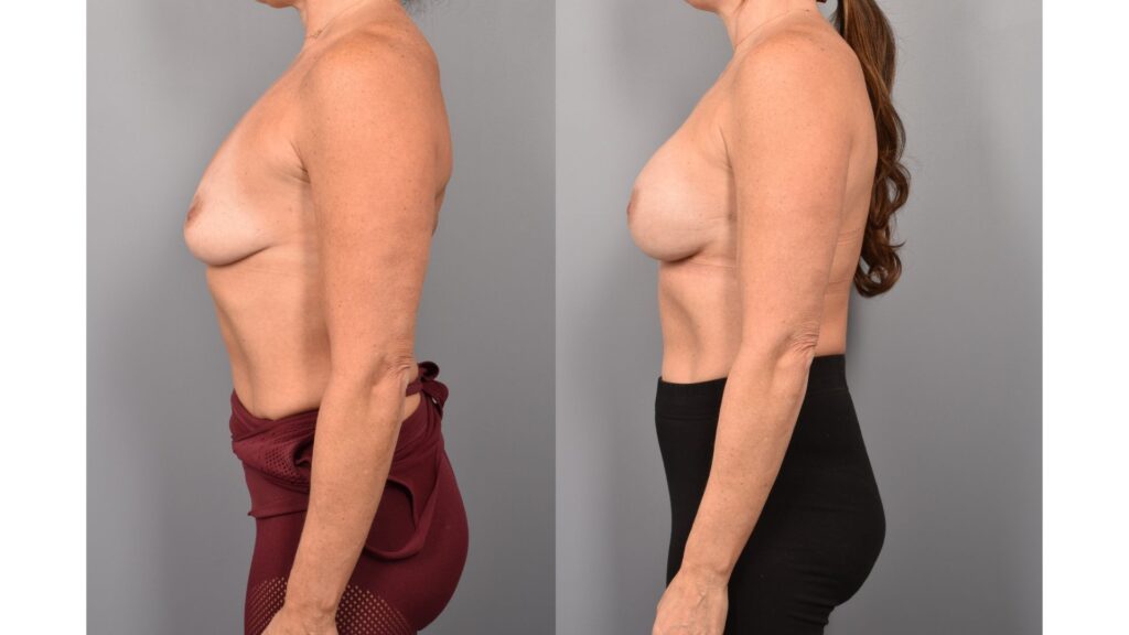 Side-by-side comparison of a female patient's left profile before and after breast augmentation by Dr. Bassiri-Tehrani. The left image shows her breast prior to surgery; the right image shows the same angle post-procedure