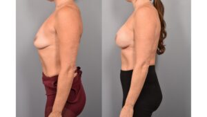 Side-by-side comparison of a female patient's left profile before and after breast augmentation by Dr. Bassiri-Tehrani. The left image shows her breast prior to surgery; the right image shows the same angle post-procedure