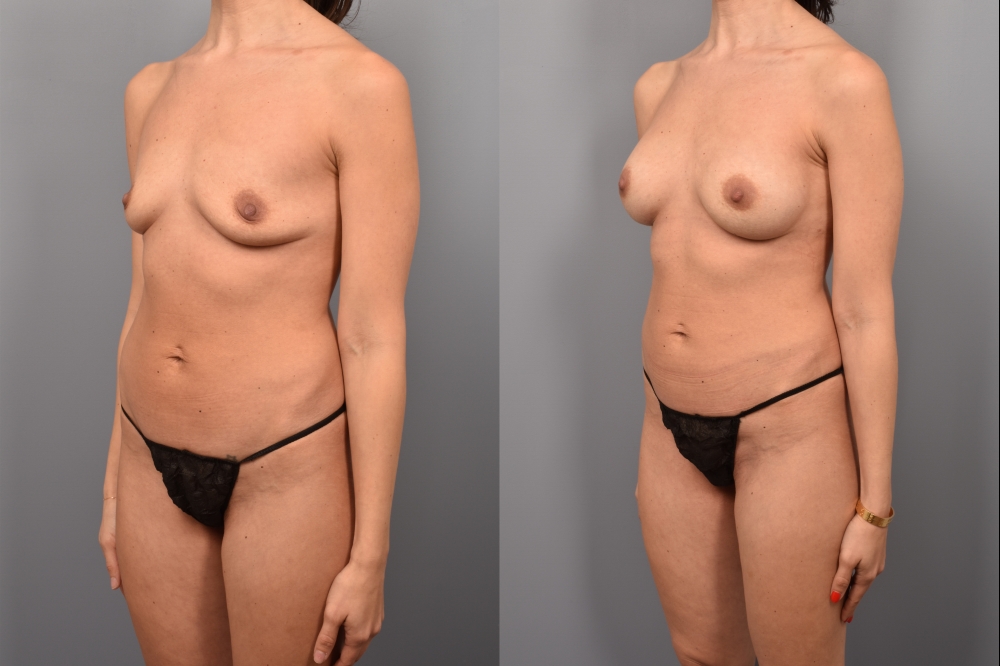 Side-by-side comparison of a female patient's left 3/4 view before and after breast augmentation by Dr. Bassiri-Tehrani. The left image shows her breast prior to surgery; the right image shows the same angle post-procedure