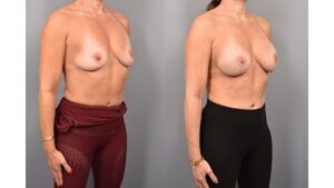 Side-by-side comparison of a female patient's right 3/4 view before and after breast augmentation by Dr. Bassiri-Tehrani. The left image shows her breast prior to surgery; the right image shows the same angle post-procedure