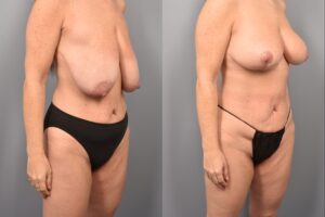 Side-by-side comparison of a female patient's right 3/4 view before and after breast lift by Dr. Bassiri-Tehrani. The left image shows her breast prior to surgery; the right image shows the same angle post-procedure