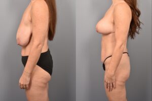 Side-by-side comparison of a female patient's left profile before and after breast lift by Dr. Bassiri-Tehrani. The left image shows her breast prior to surgery; the right image shows the same angle post-procedure