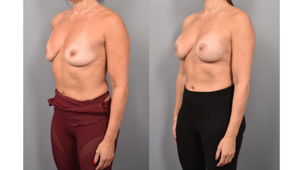 Side-by-side comparison of a female patient's left 3/4 view before and after breast augmentation by Dr. Bassiri-Tehrani. The left image shows her breast prior to surgery; the right image shows the same angle post-procedure