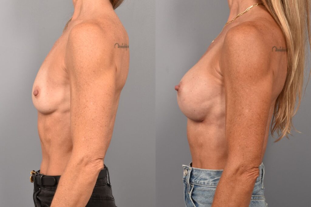Side-by-side comparison of a female patient's left profile before and after breast lift by Dr. Bassiri-Tehrani. The left image shows her breast prior to surgery; the right image shows the same angle post-procedure